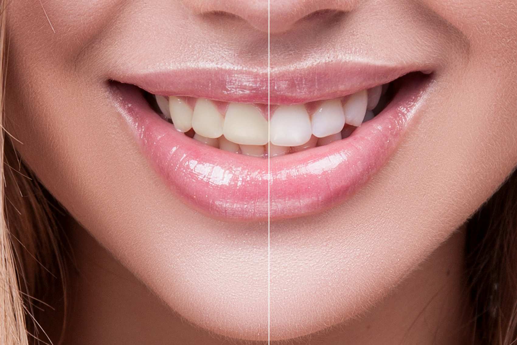 Branqueamento Dentário no Porto